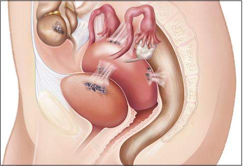 lạc nội mạc tử cung, phương pháp điều trị, buồng trứng, thuốc giảm đau, ngưng rụng trứng, phẫu thuật, u nang, cắt bỏ tử cung