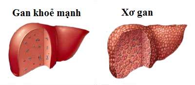 các biến chứng của viên gan b, suy gan ở người bị viêm gan b, viêm gan b dẫn đến xơ gan, ung thư gan do viêm gan b, phòng viêm gan b, tiêm phòng viêm gan b, theo dõi viêm gan b